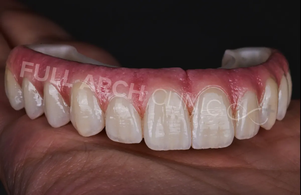 Full-arch prosthesis with hand-layered pink and incisal ceramics