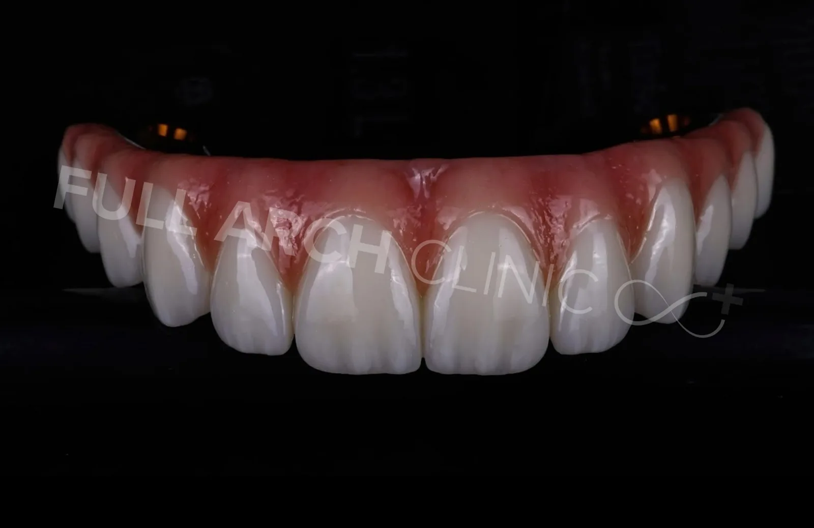 Upper full-arch prosthesis, frontal view